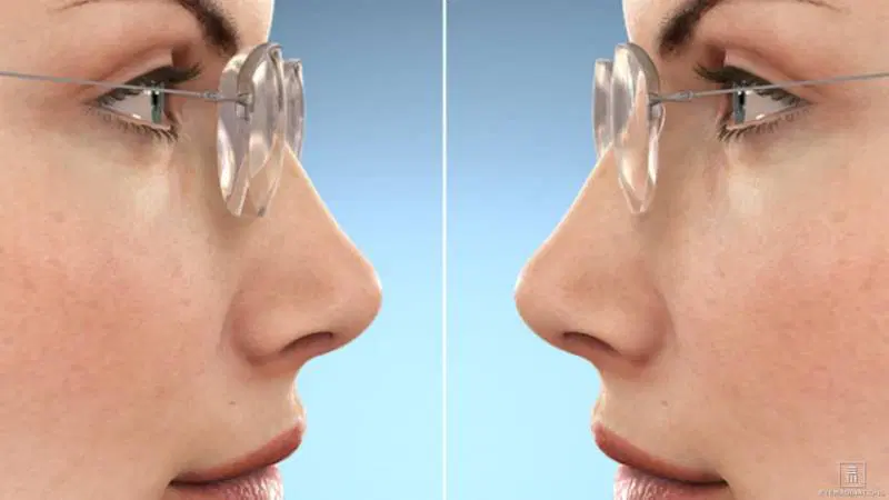 ایندکس عدسی